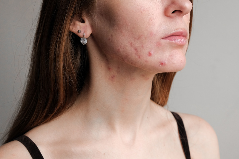 Skin issues and breakouts